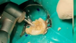 دندان دایمی تازه رویش یافته