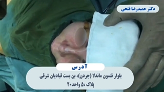 فیلم ترمیم بینی عمل شده