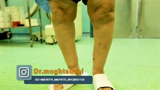 وقتی انحراف شدید زانو راه رفتن را برای شما دشوار کند...