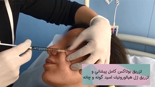 فیلم تزریق ژل هیالورونیک اسید گونه و چانه