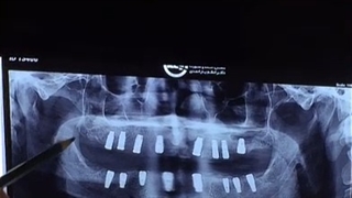 کاشت 16 واحد ایمپلنت دندان بصورت هم زمان توسط دکتر شهرام اسعدی کلینیک مو