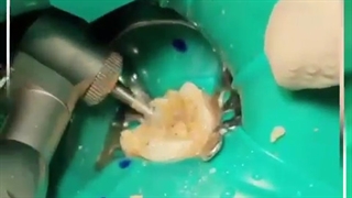 دندان دایمی تازه رویش یافته