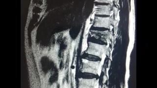 شکستگی مهره T12 در سه ستون قدامی میانی و خلفی با معیار TLICS:5