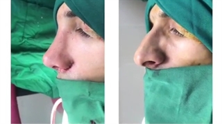 جراحی بینی طبیعی و مردانه