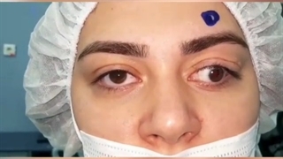 اصلاح انحراف چشم شدید بدلیل دید کم وعملهای متعدد شبکیه و گلوکوم