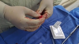 لیزیس مهره ها