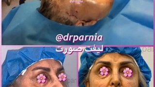 لیفت صورت