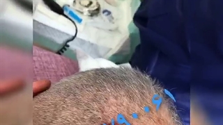 آموزش کاشت مو کامل