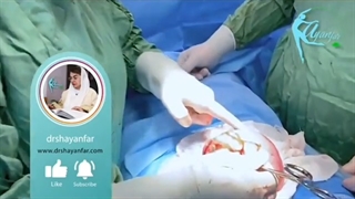 جراحی توده بزرگ رحمی