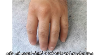 پروتز زیبایی زیر آرنج ساخته شده در کلینیک ارتوپدی فنی حکیم