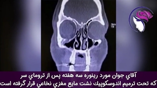 فیلم واقعی جراحی آندوسکوپیک نشت مایع مغزی نخاعی ناشی از ضربه مغزی