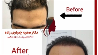فیلم واقعی کاشت مو و نتیجه بعد از 8 ماه