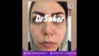 تزریق فیلر ناحیه گونه و کمی در لب