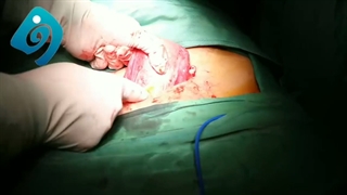 هیستروسکوپی