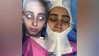 جراحی بینی با پوست نازک و قاعده پهن | دکتر باستانی نژاد
