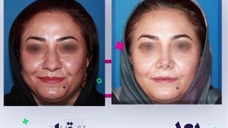 فیلم عمل بینی گوشتی با نتیجه کاملا طبیعی