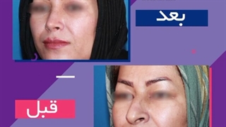 فیلم همزمان عمل بینی و عمل پلک در مشهد