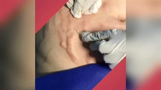 رفع ترک های شکم بعد از بارداری