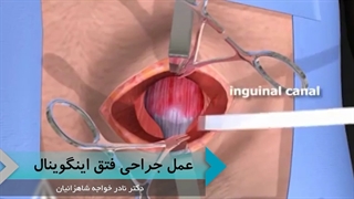 عمل جراحی فتق اینگوینال