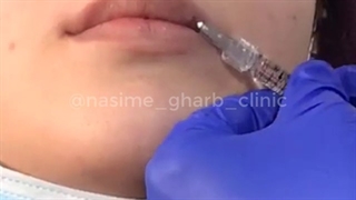 جذابیت بیشتر با تزریق ژل لب