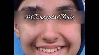 درمان ارتودنسی ثابت دو فک بدون کشیدن دندان | کلینیک تخصصی دندانپزشکی کانسپتا