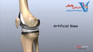 فیلم تعویض مفصل زانو از دکتر واعظی لیفت ابرو