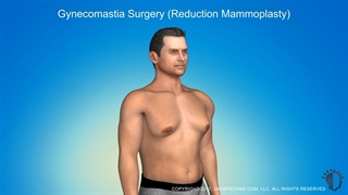فیلم جراحی کوچک کردن سینه در آقایان