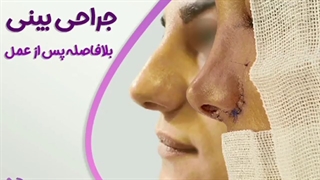 بلافاصله و یک هفته بعد از عمل بینی