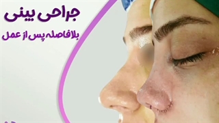 فیلم عمل بینی بلافاصله پس از اتمام جراحی