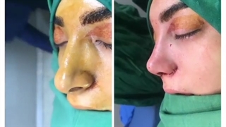 چند نما از نتیجه جراحی زیبایی بینی
