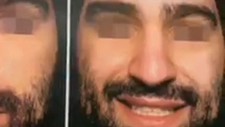 عمل بینی مردی جوان