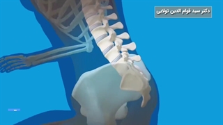 پیشگیری از کمردرد
