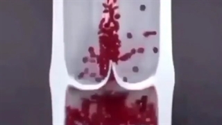 فیلمی از خطرات واریس در صورت عدم درمان به موقع