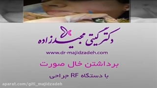 برداشتن خال صورت با دستگاه RF