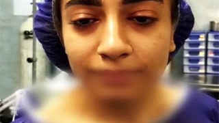 رینوپلاستی بینی گوشتی غضروفی