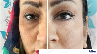 نمونه بلفاروپلاستی دکتر مهدیه