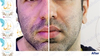 نمونه عمل بلفاروپلاستی دکتر مهدیه