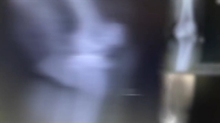 تعویض مفصل کامل زانو TKA در خانم هفتاد ساله