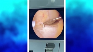 آرتروسکوپى بازسازى رباط صلیبى زانو ACL