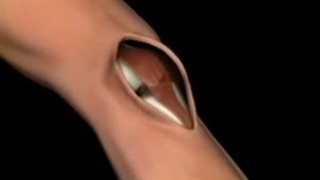 فیلم نحوه جراحی تعویض مفصل زانو