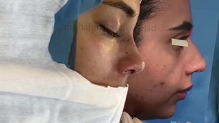 جراحی بینی در بیمار با نوک بینی پهن و کلوملای توکشیده | دکتر باستانی نژاد
