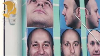 جراحی بینی با انحراف شدید