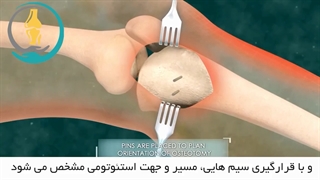 جراحی استئوتومی تیبیا در اصلاح پای پرانتزی بیمار