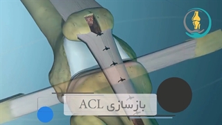 جراحى رباط صلیبى قدامى