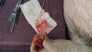 تومور بزرگ مغزی