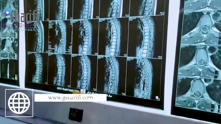 جراحی خانم جوان با تومور نخاع