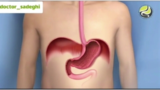 فیلم ریفلاکس معده به مری