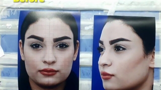 نمونه جراحی زیبایی بینی