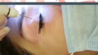 فیلم رفع افتادگی پلک و لیفت ابرو بدون جراحی