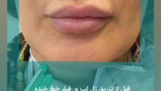 فیلم رفع خطوط خنده + تزریق ژل لب